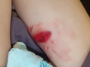 Под Смоленском на девочку напали агрессивные собаки